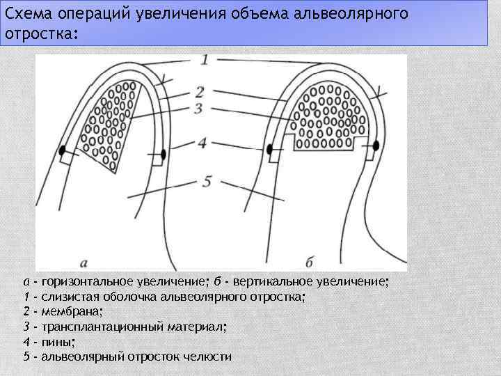 Схема операций увеличения объема альвеолярного отростка: а - горизонтальное увеличение; б - вертикальное увеличение;