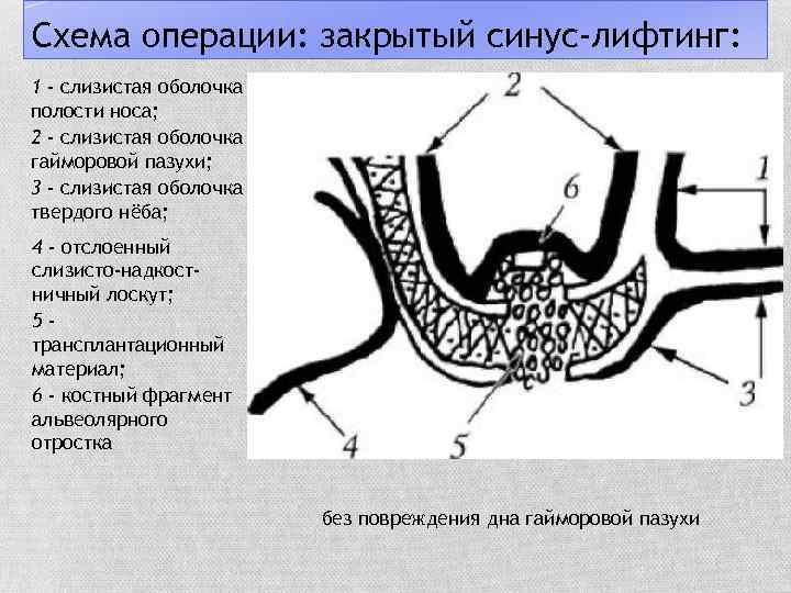Схема операции: закрытый синус-лифтинг: 1 - слизистая оболочка полости носа; 2 - слизистая оболочка
