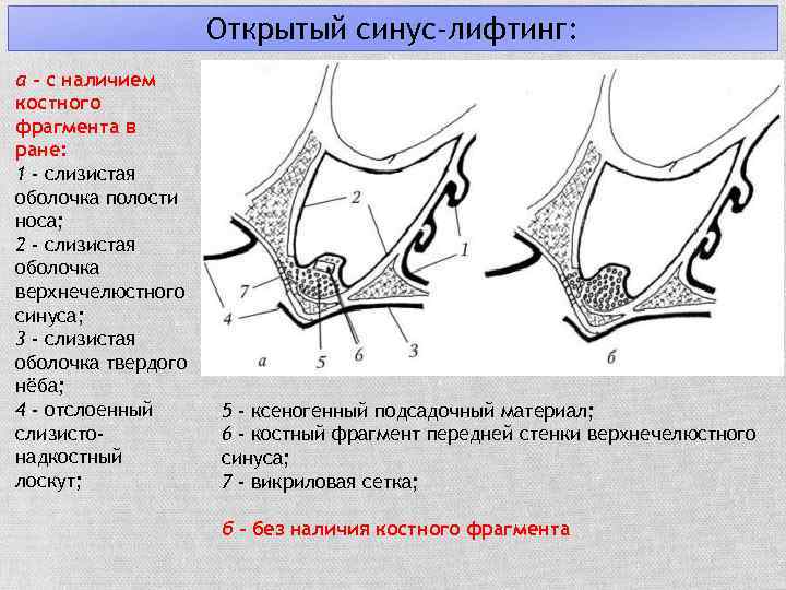 Открытый синус-лифтинг: а - с наличием костного фрагмента в ране: 1 - слизистая оболочка