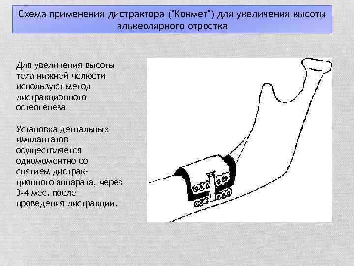 Схема применения дистрактора (