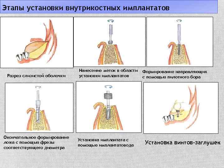 Этапы установки внутрикостных имплантатов Разрез слизистой оболочки Окончательное формирование ложа с помощью фрезы соответствующего