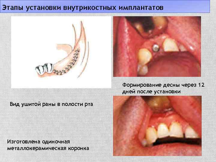 Этапы установки внутрикостных имплантатов Формирование десны через 12 дней после установки Вид ушитой раны