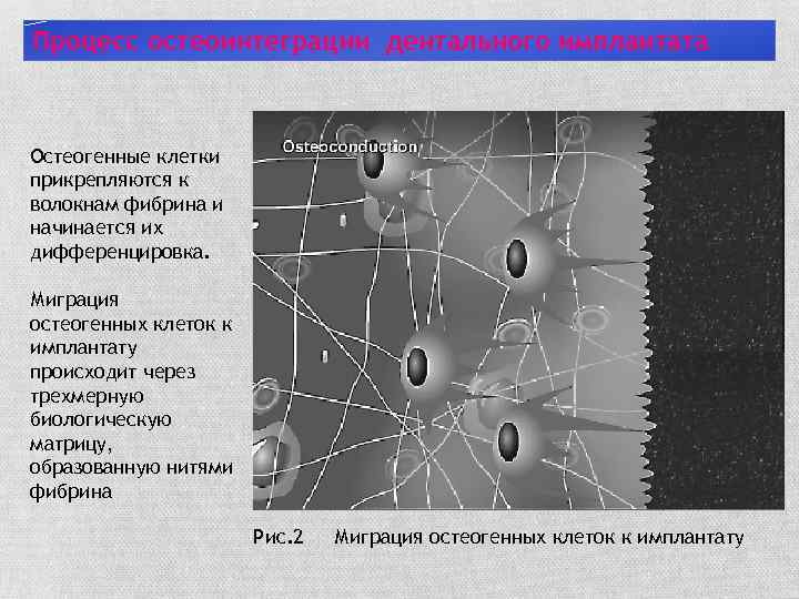 Процесс остеоинтеграции дентального имплантата Остеогенные клетки прикрепляются к волокнам фибрина и начинается их дифференцировка.