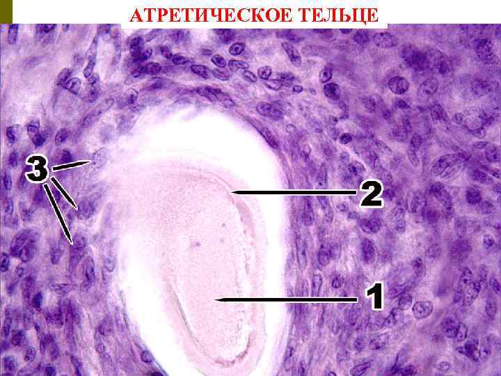 АТРЕТИЧЕСКОЕ ТЕЛЬЦЕ 