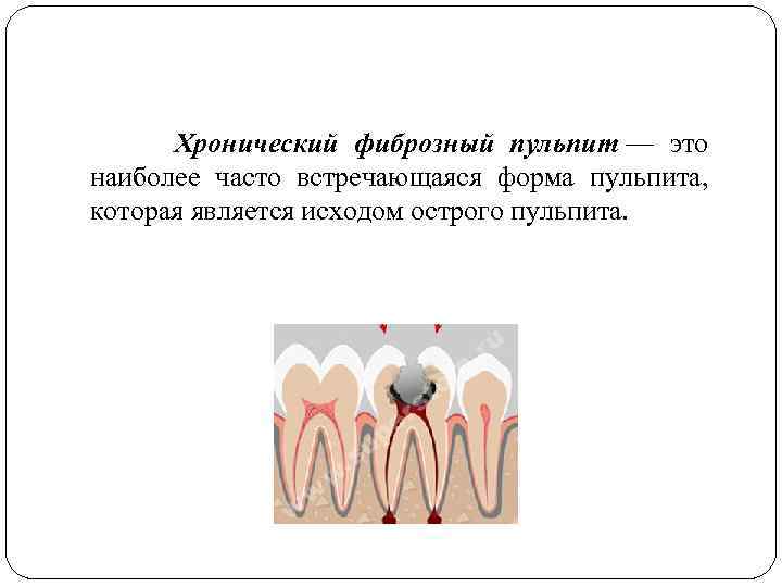  Хронический фиброзный пульпит — это наиболее часто встречающаяся форма пульпита, которая является исходом