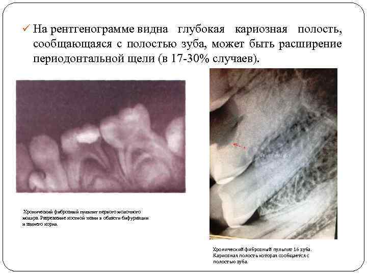 ü На рентгенограмме видна глубокая кариозная полость, сообщающаяся с полостью зуба, может быть расширение