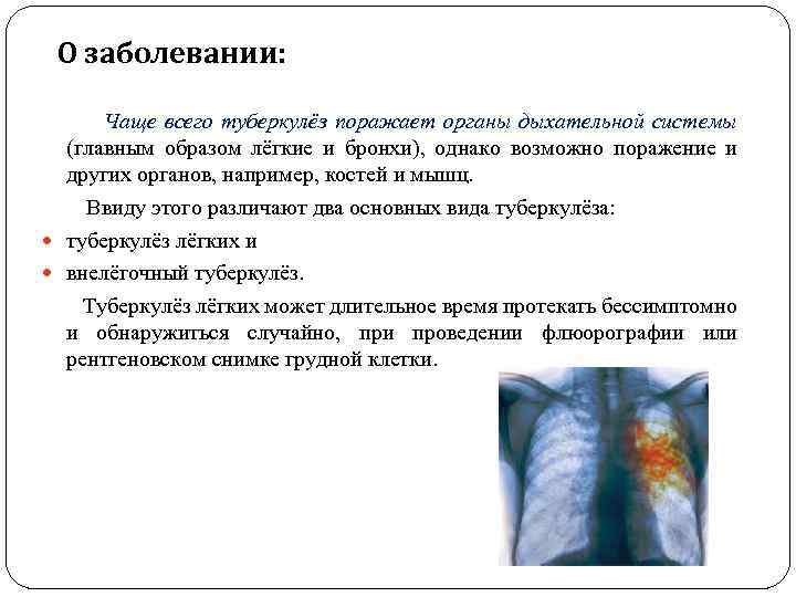 О заболевании: Чаще всего туберкулёз поражает органы дыхательной системы (главным образом лёгкие и бронхи),