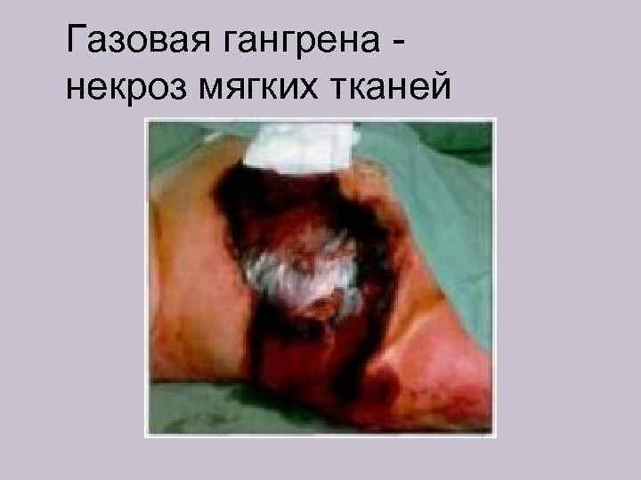 Газовая гангрена некроз мягких тканей 