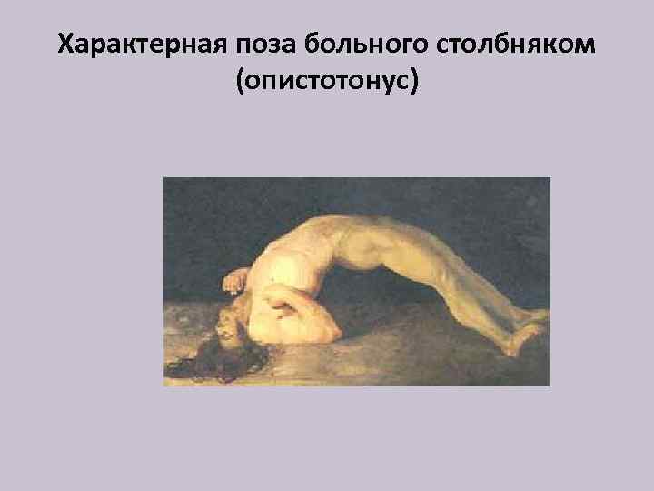 Характерная поза больного столбняком (опистотонус) 