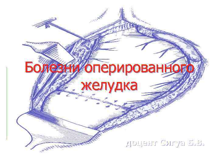 СЗГМУ им. И. И. Мечникова Кафедра факультетской хирургии Болезни оперированного желудка доцент Сигуа Б.