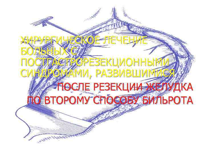 ХИРУРГИЧЕСКОЕ ЛЕЧЕНИЕ БОЛЬНЫХ С ПОСТГАСТРОРЕЗЕКЦИОННЫМИ СИНДРОМАМИ, РАЗВИВШИМИСЯ ПОСЛЕ РЕЗЕКЦИИ ЖЕЛУДКА ПО ВТОРОМУ СПОСОБУ БИЛЬРОТА