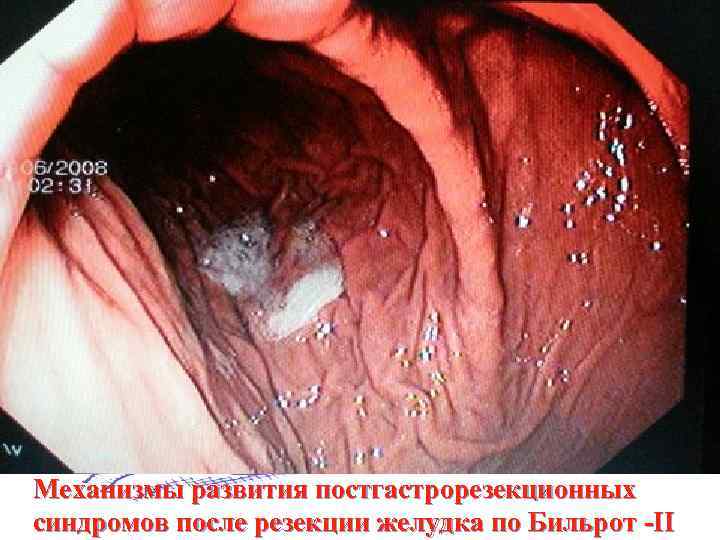 Механизмы развития постгастрорезекционных синдромов после резекции желудка по Бильрот -II 