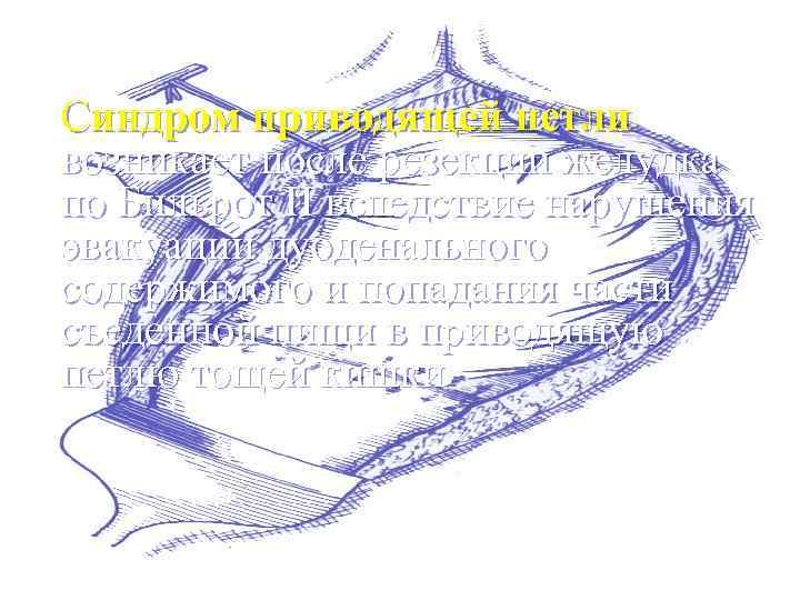 Синдром приводящей петли возникает после резекции желудка по Бильрот II вследствие нарушения эвакуации дуоденального