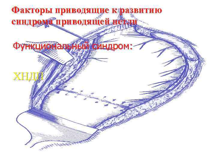 Факторы приводящие к развитию синдрома приводящей петли Функциональный синдром: ХНДП 
