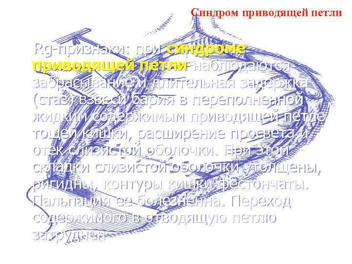 Синдром приводящей петли Rg-признаки: при синдроме приводящей петли наблюдаются забрасывание и длительная задержка (стаз)