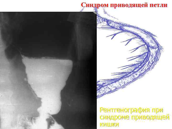 Синдром приводящей петли Рентгенография при синдроме приводящей кишки 