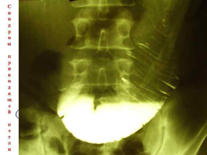 С и н д р о м п р и в о д я