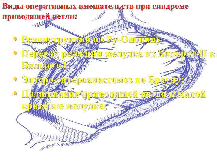 Виды оперативных вмешательств при синдроме приводящей петли: • Реконструкция по Ру-Опокину • Перевод резекции