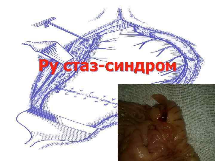 Ру стаз-синдром 