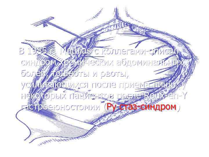  В 1985 г. Mathias с коллегами описал синдром хронических абдоминальных болей, тошноты и