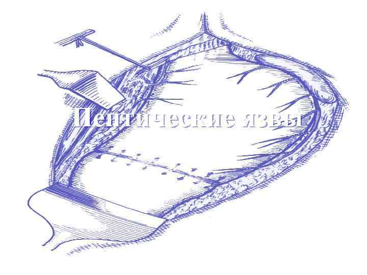 Пептические язвы 