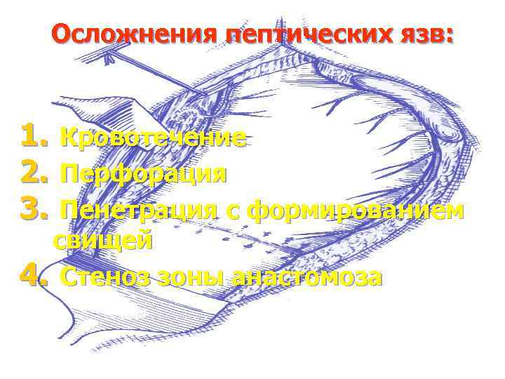 Осложнения пептических язв: 1. 2. 3. Кровотечение Перфорация Пенетрация с формированием свищей 4. Стеноз