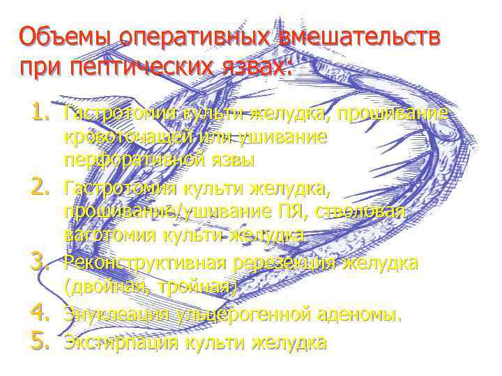 Объемы оперативных вмешательств при пептических язвах: 1. Гастротомия культи желудка, прошивание 2. 3. 4.