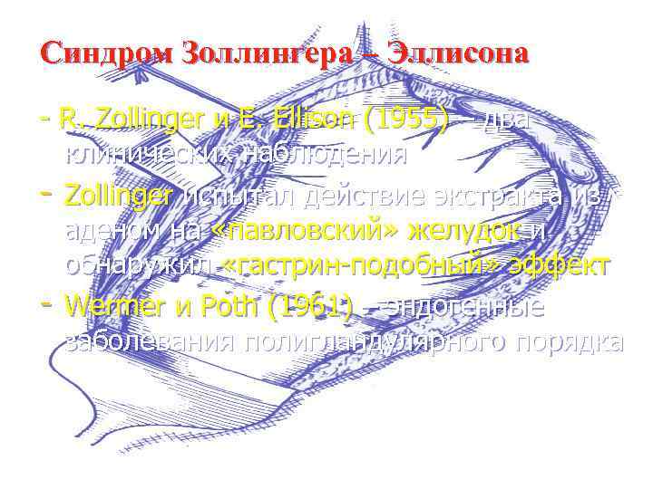 Синдром Золлингера – Эллисона - R. Zollinger и E. Ellison (1955) – два клинических