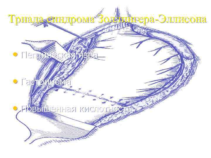 Триада синдрома Золлингера-Эллисона • Пептическая язва • Гастринома • Повышенная кислотность 