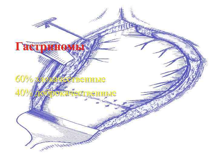 Гастриномы 60% злокачественные 40% доброкачественные 