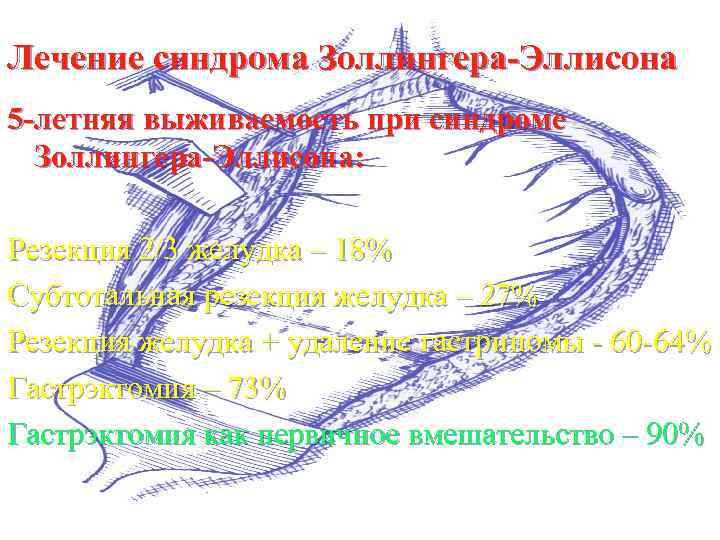 Лечение синдрома Золлингера-Эллисона 5 -летняя выживаемость при синдроме Золлингера-Эллисона: Резекция 2/3 желудка – 18%