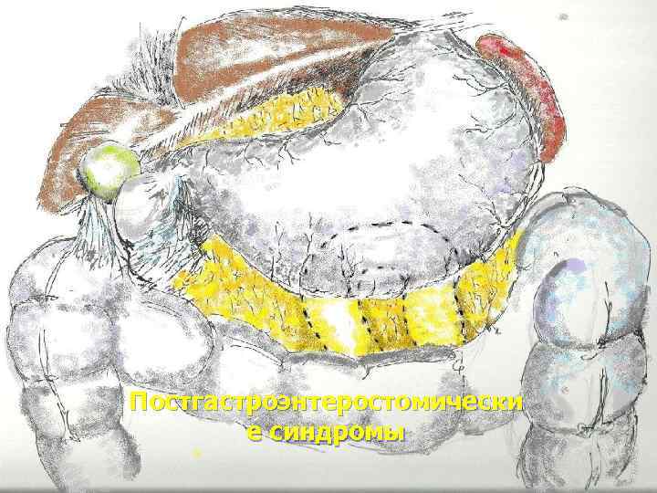 Постгастроэнтеростомически е синдромы 