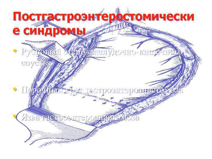 Постгастроэнтеростомически е синдромы • Рубцовый стеноз желудочно-кишечного соустья • Порочный круг гастроэнтероанастомоза • Язва
