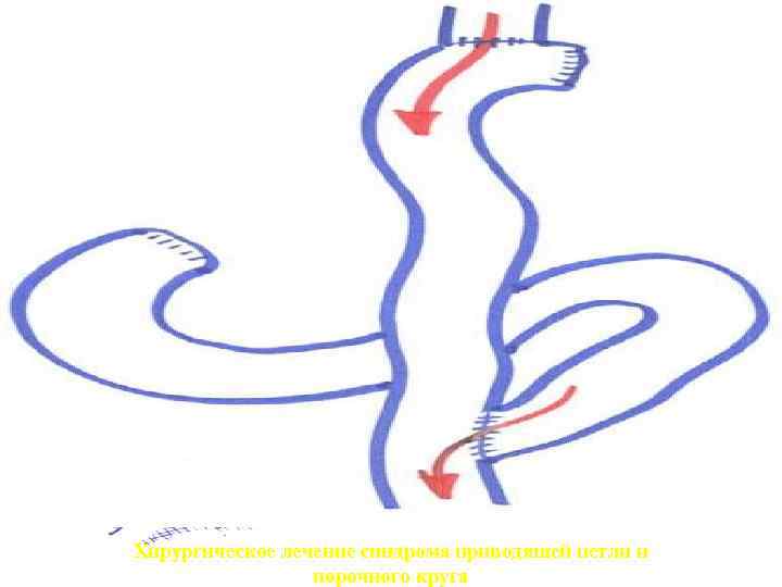 Хирургическое лечение синдрома приводящей петли и порочного круга 