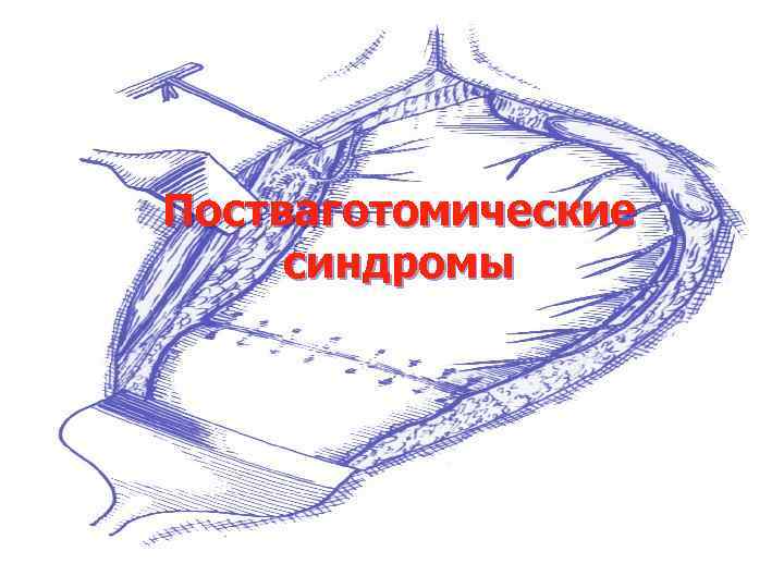 Постваготомические синдромы 