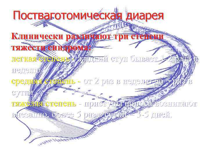Постваготомическая диарея Клинически различают три степени тяжести синдрома: легкая степень - жидкий стул бывает
