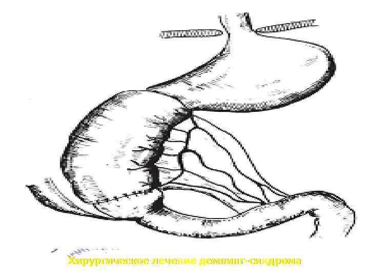 Хирургическое лечение демпинг-синдрома 