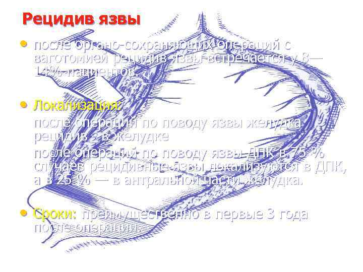 Рецидив язвы • после органо-сохраняющих операций с ваготомией рецидив язвы встречается у 8— 14%
