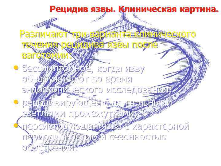 Рецидив язвы. Клиническая картина. Различают три варианта клинического течения рецидива язвы после ваготомии: •