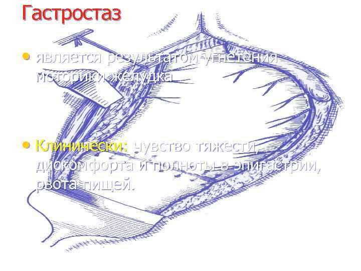 Гастростаз • является результатом угнетения моторики желудка • Клинически: чувство тяжести, дискомфорта и полноты