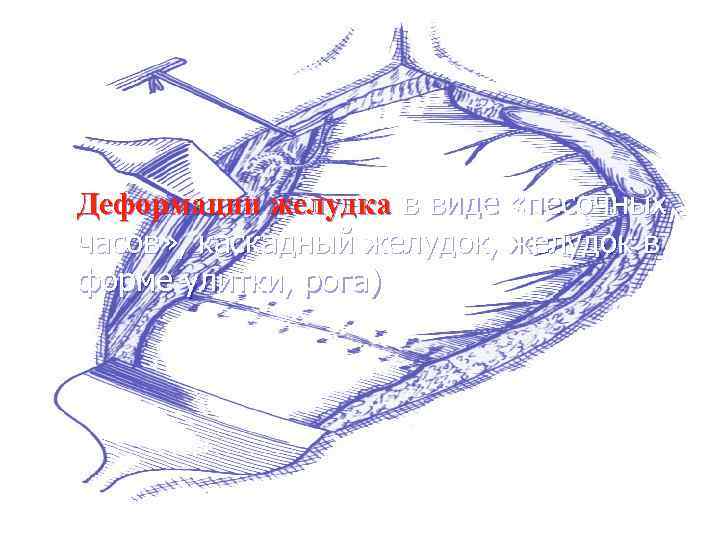 Деформации желудка в виде «песочных часов» , каскадный желудок, желудок в форме улитки, рога)