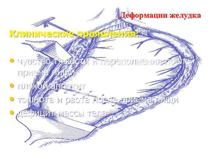 Деформации желудка Клинические проявления: • чувство тяжести и переполнения после приема пищи • плохой
