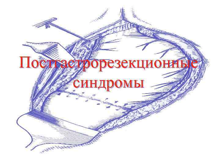 Постгастрорезекционные синдромы 