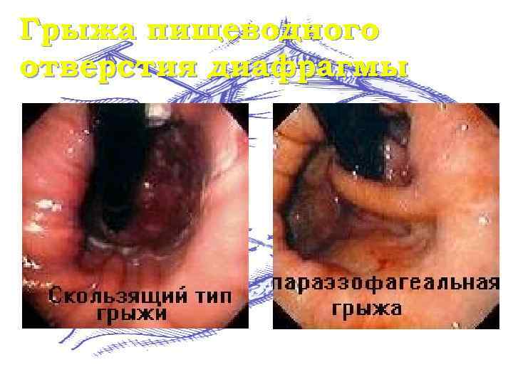 Грыжа пищеводного отверстия диафрагмы 