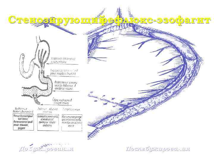 Стенозирующий рефлюкс-эзофагит До бужирования После бужирования 
