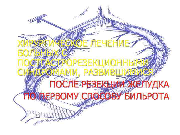 ХИРУРГИЧЕСКОЕ ЛЕЧЕНИЕ БОЛЬНЫХ С ПОСТГАСТРОРЕЗЕКЦИОННЫМИ СИНДРОМАМИ, РАЗВИВШИМИСЯ ПОСЛЕ РЕЗЕКЦИИ ЖЕЛУДКА ПО ПЕРВОМУ СПОСОБУ БИЛЬРОТА