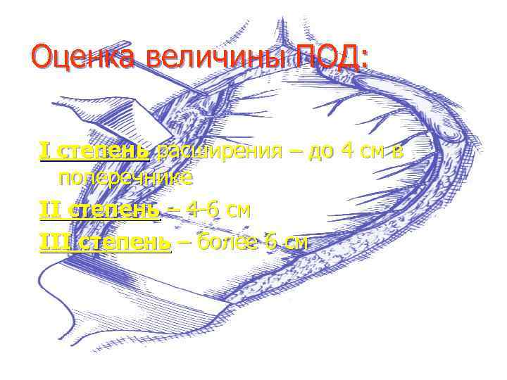 Оценка величины ПОД: I степень расширения – до 4 см в поперечнике II степень