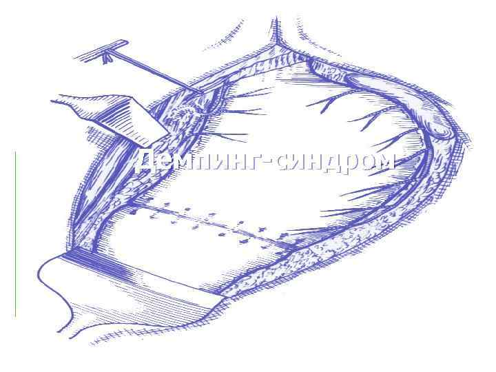  Демпинг-синдром 