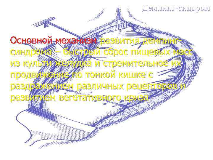 Демпинг-синдром Основной механизм развития демпингсиндрома – быстрый сброс пищевых масс из культи желудка и