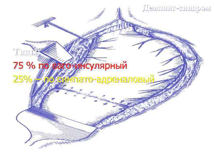 Демпинг-синдром Типы: 75 % по ваго-инсулярный 25% – по симпато-адреналовый 